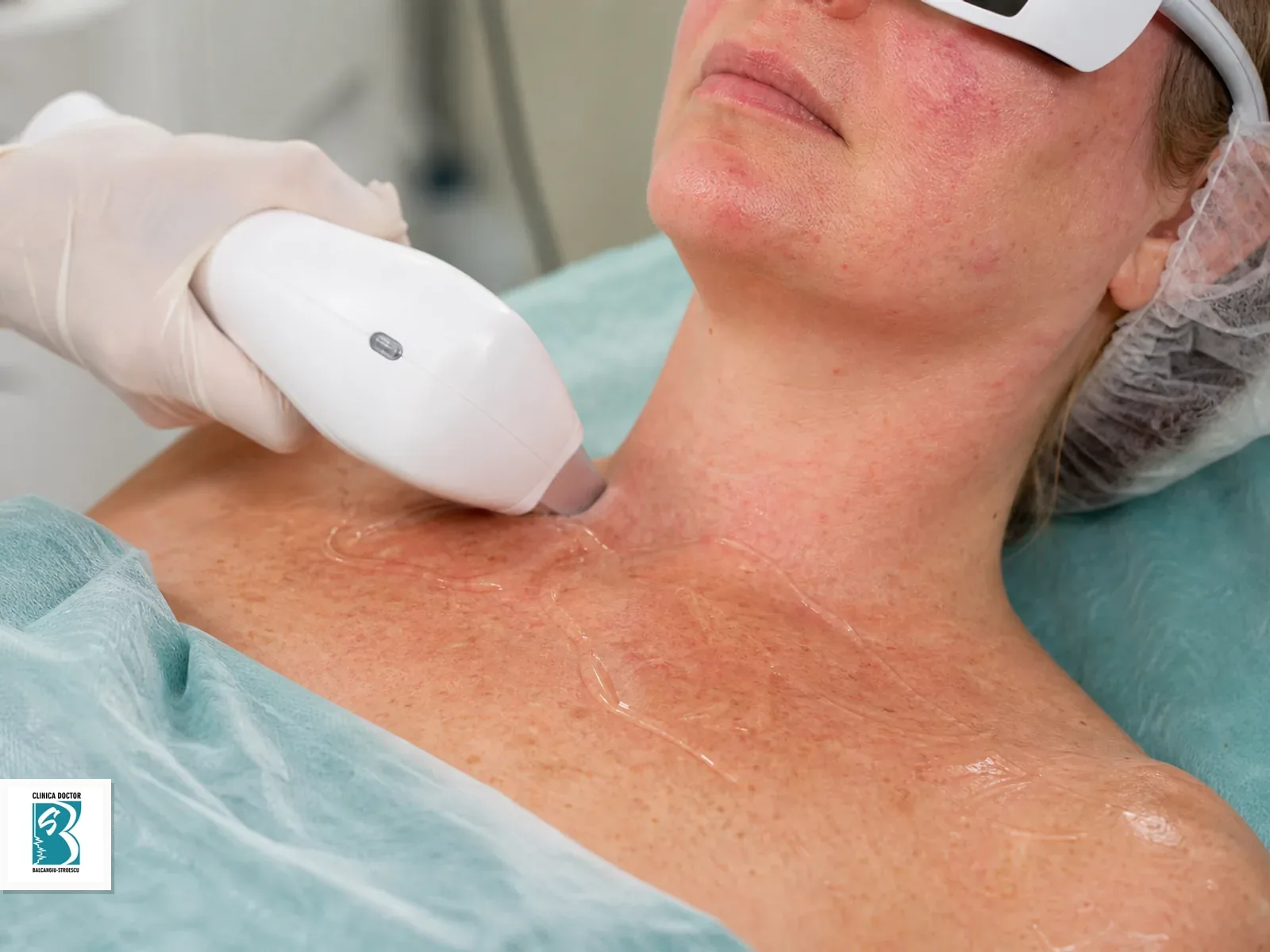 IPL Vascular & Rejuvenare - Rozacee, Vase Sparte, Anti-Aging - fata, gat, decolteu Tratament IPL vascular pentru decolteului, cu roseata si vase fine vizibile