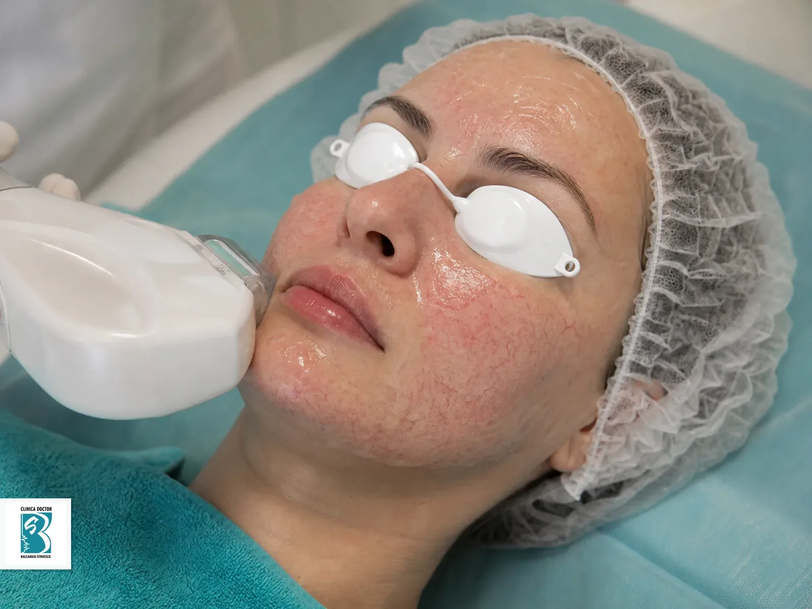 IPL Vascular & Rejuvenare - Rozacee, Vase Sparte, Anti-Aging - fata integral Tratament IPL vascular pentru intregii fete, cu roseata si vase fine vizibile