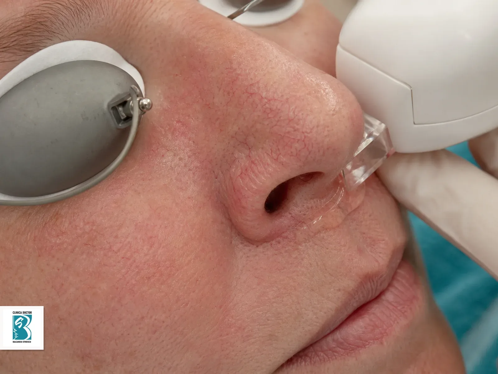 IPL Vascular & Rejuvenare - Rozacee, Vase Sparte, Anti-Aging - nas/perinazal Tratament IPL vascular pentru nasului si zonei perinazale, cu roseata si vase fine vizibile