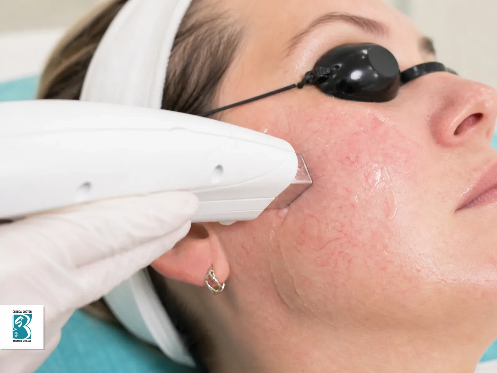 IPL Vascular & Rejuvenare - Rozacee, Vase Sparte, Anti-Aging - obraji/pometi Tratament IPL vascular pentru obrajilor si pometilor, cu roseata si vase fine vizibile