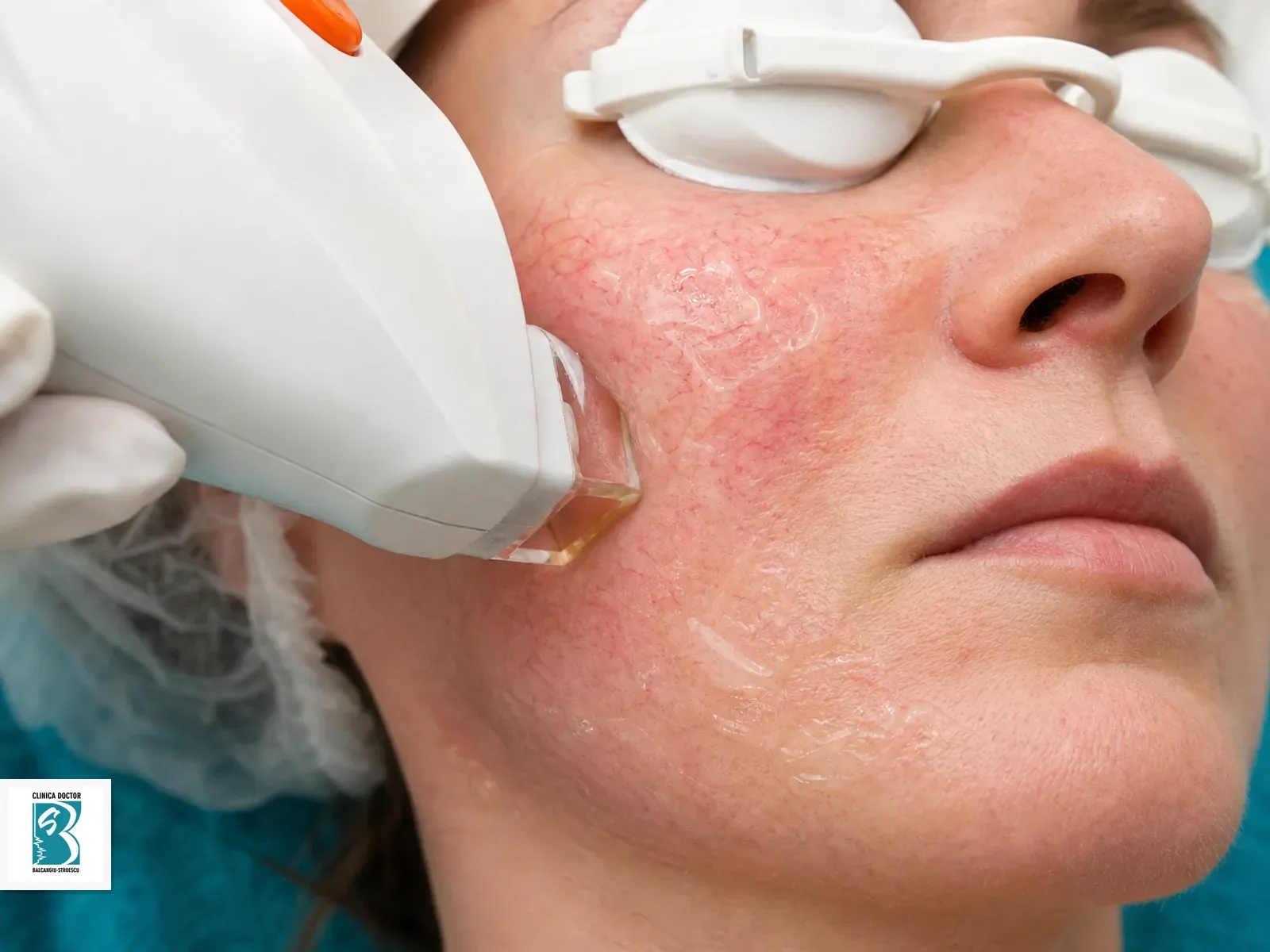 IPL Vascular & Rejuvenare - Rozacee, Vase Sparte, Anti-Aging - zone vasculare localizate Tratament IPL vascular pentru zonei tratate, cu roseata si vase fine vizibile