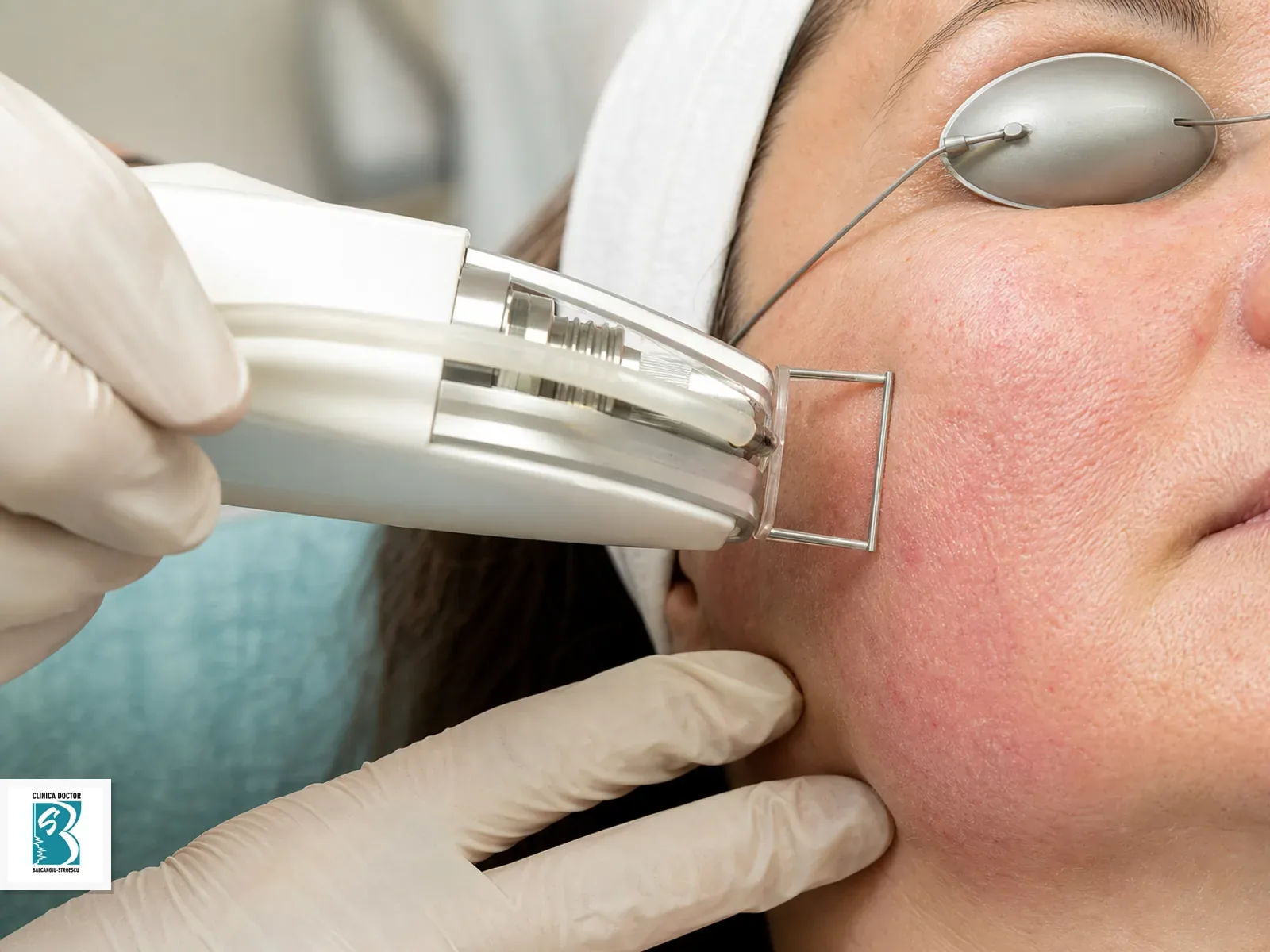 Laser Erbium YAG - rejuvenare profunda si resurfacing facial Resurfacing facial cu laser Erbium YAG pe obraz