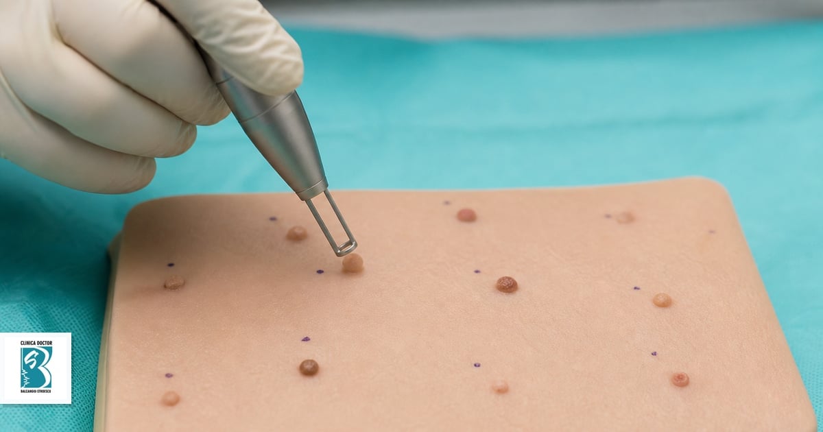 Tratament condiloame HPV cu laser – îndepărtare 8–12 leziuni