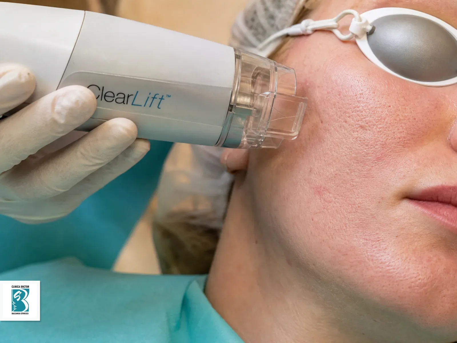 Rejuvenare cu laser non-ablativ ClearLift + ClearSkin Rejuvenare laser non-ablativa ClearLift si ClearSkin pe obraz