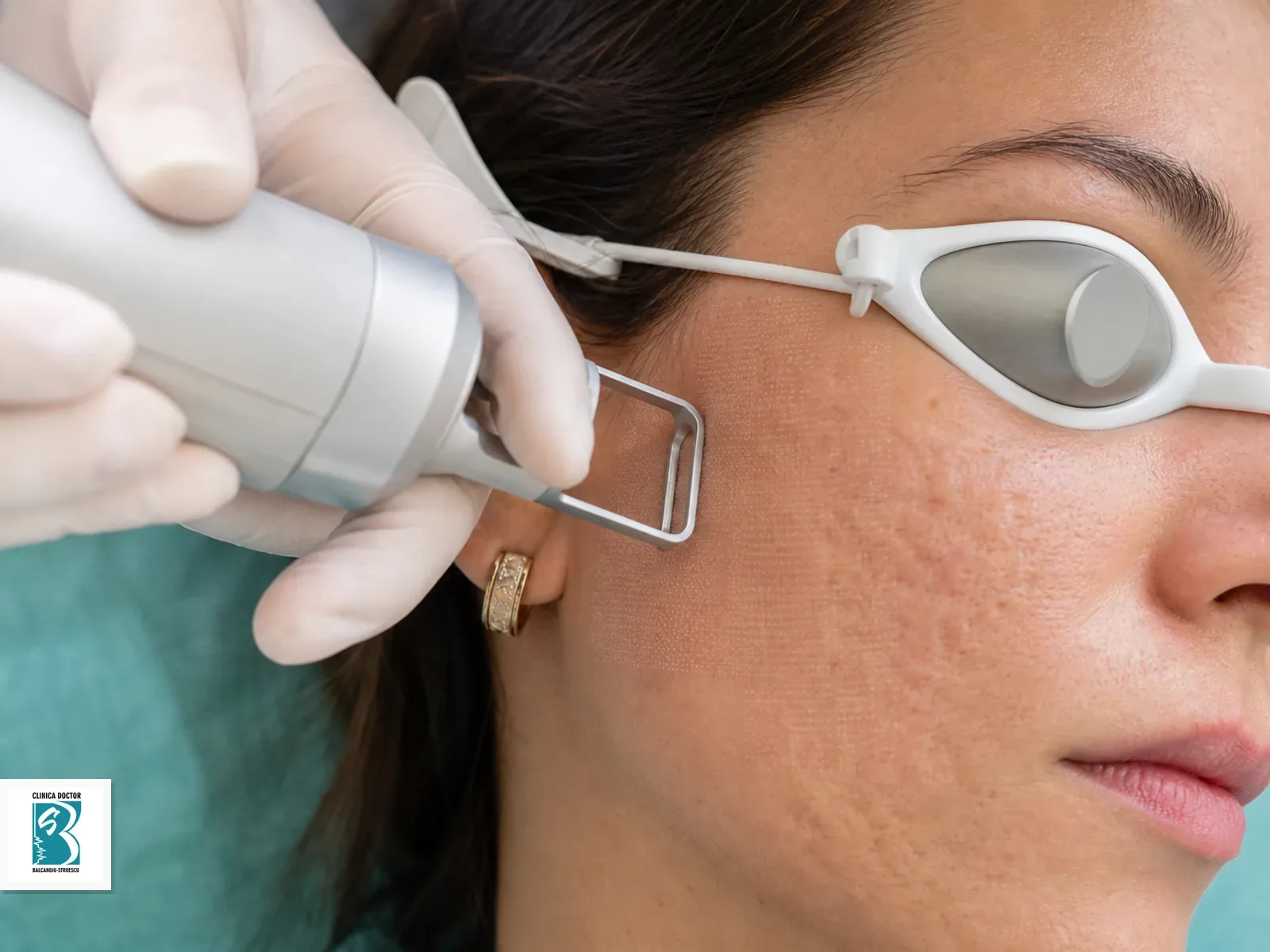 Tratament cicatrici acneice full face (20cm/20cm jumatate din fata)- laser fractionat CO2 ultrapulsat Tratament laser pentru cicatrici acneice full face