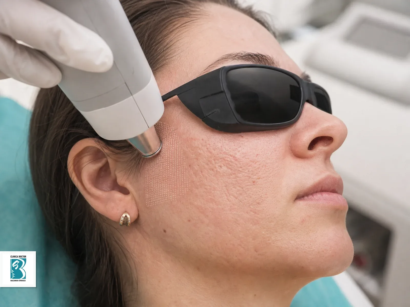 Tratament cicatrici acneice full face - laser hibrid Tratament laser pentru cicatrici acneice full face