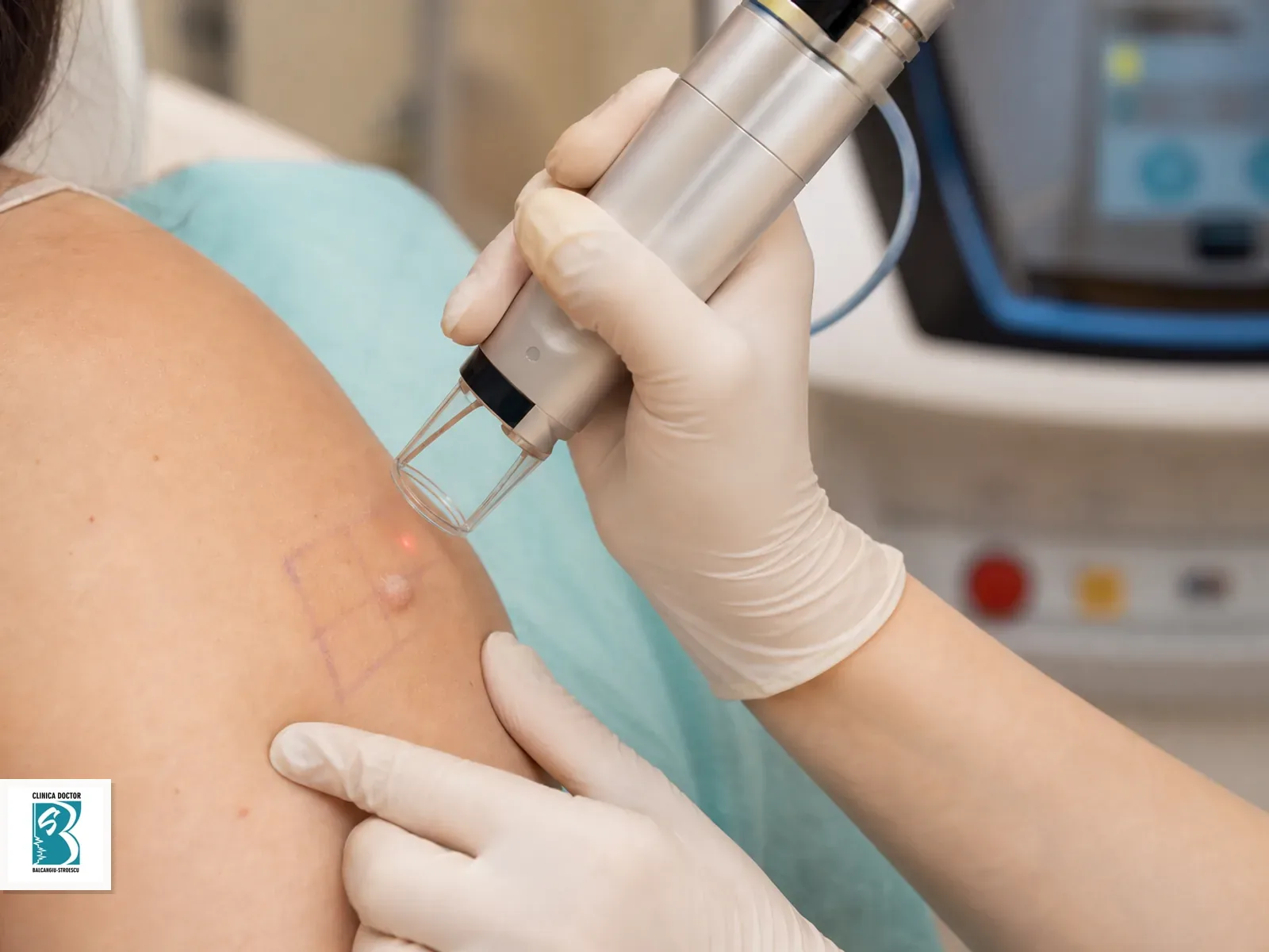 Tratament cicatrici hipertrofice si cheloidiene cu laser CO2 fractionat ultrapulsat - cicatrice pana la 4 cm Tratament laser pentru cicatrice hipertrofica sau cheloidiana mica