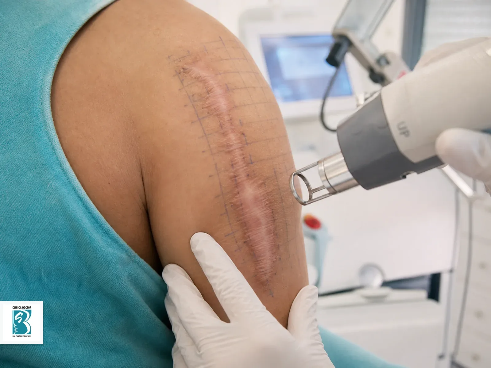 Tratament cicatrici hipertrofice si cheloidiene cu laser CO2 fractionat ultrapulsat - cicatrice peste 4 cm sau leziuni multiple Tratament laser pentru cicatrice hipertrofica sau cheloidiana extinsa
