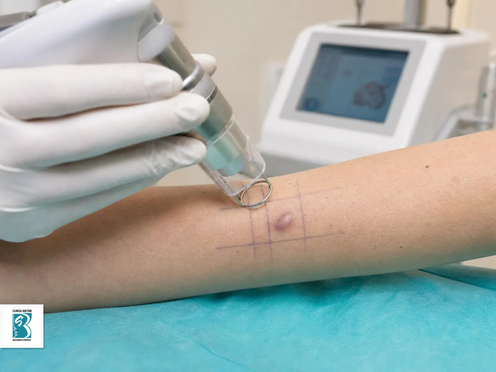 Tratament cicatrici hipertrofice si cheloidiene cu laser hibrid - cicatrice pana la 4 cm Tratament laser pentru cicatrice hipertrofica sau cheloidiana mica