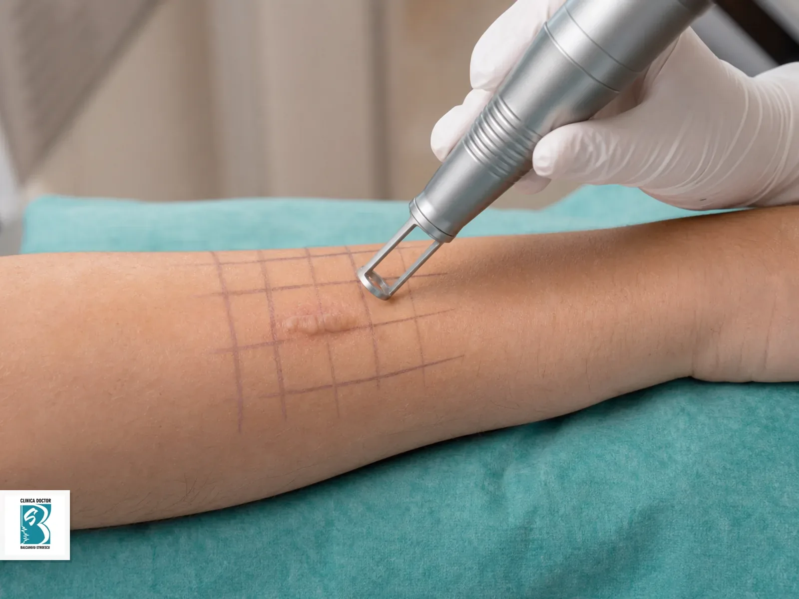 Tratament cicatrici hipertrofice si cheloidiene suprafata mica(obraji, tample) cu laser hibrid Tratament laser pentru cicatrice hipertrofica sau cheloidiana mica
