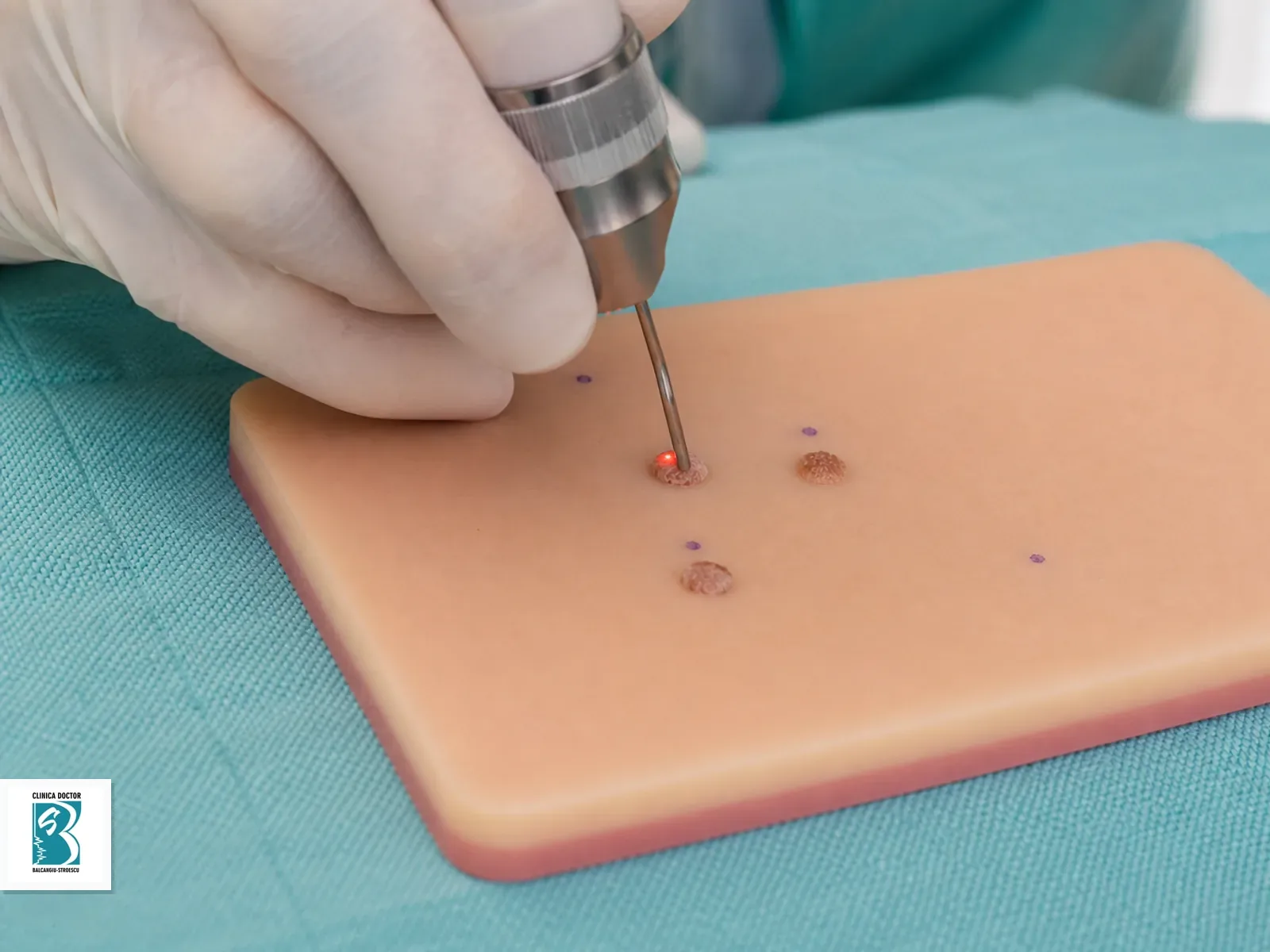 Tratament condiloame HPV cu laser - indepartare 2-3 leziuni Tratament laser pentru condiloame HPV, reprezentare clinica non-explicita cu doua-trei leziuni mici intr-un camp de tratament marcat clinic