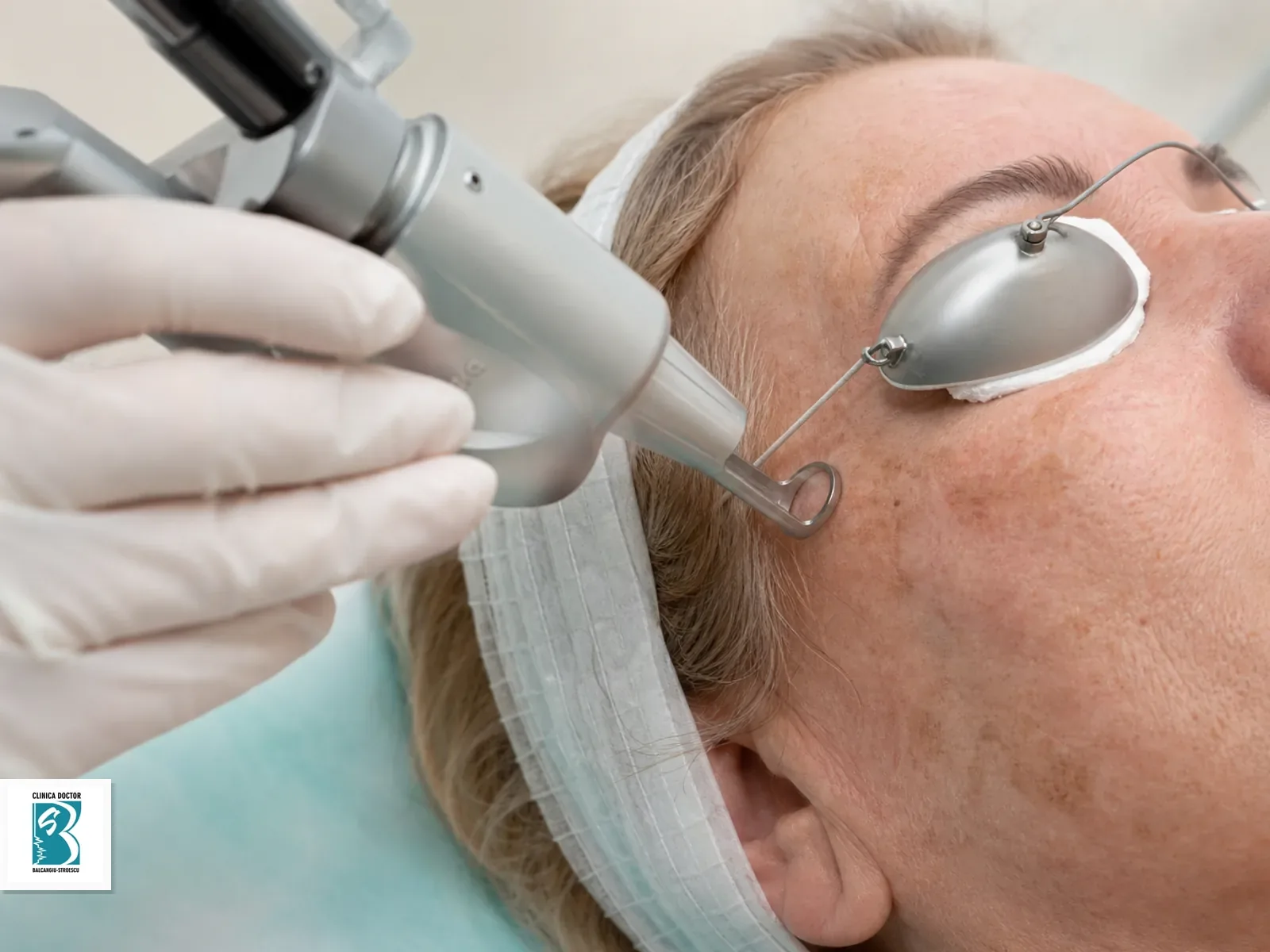 Tratament fotoimbatranire - rejuvenare cu laser ClearLift QS Nd:YAG 1064 nm Rejuvenare laser ClearLift pentru fotoimbatranire pe obraz si tampla