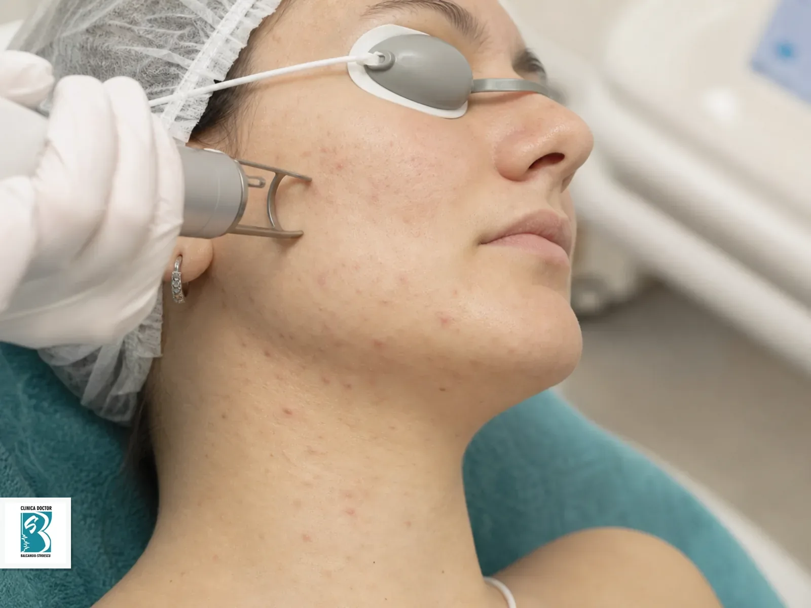 Tratament laser acnee fata si gat - Er:Glass 1540 nm Tratament laser Er:Glass 1540 nm pentru acnee pe fetei si gatului