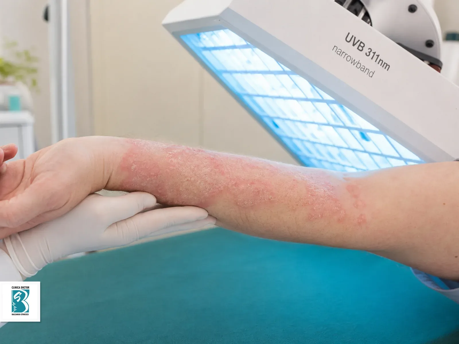 Fototerapie UVB narrowband pentru psoriazis sau dermatita pe antebrat