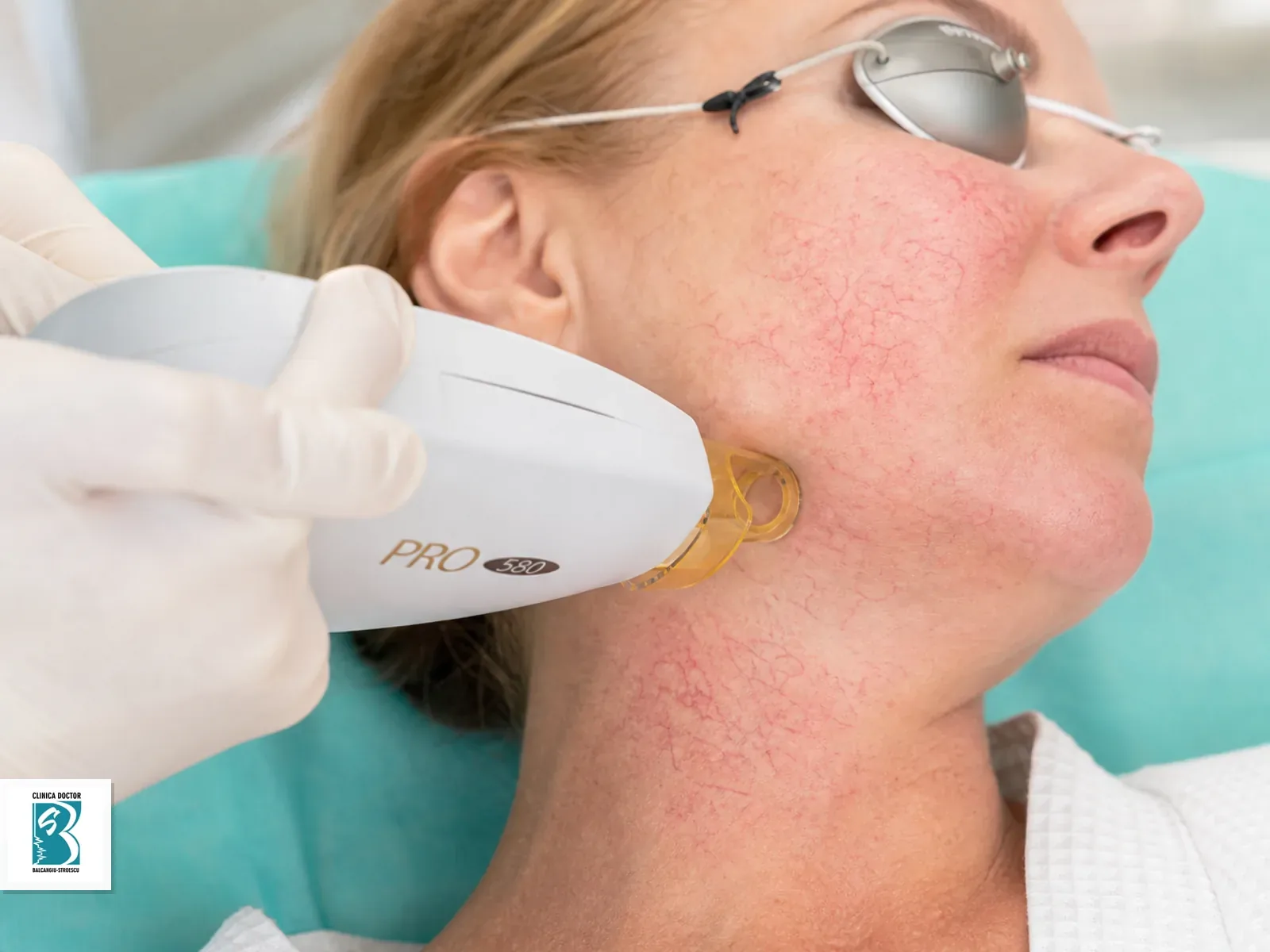 Tratament telangiectazii / venectazii - fata si gat (Laser Harmony Dye VL PRO) Tratament laser vascular pentru fetei si gatului, cu telangiectazii fine