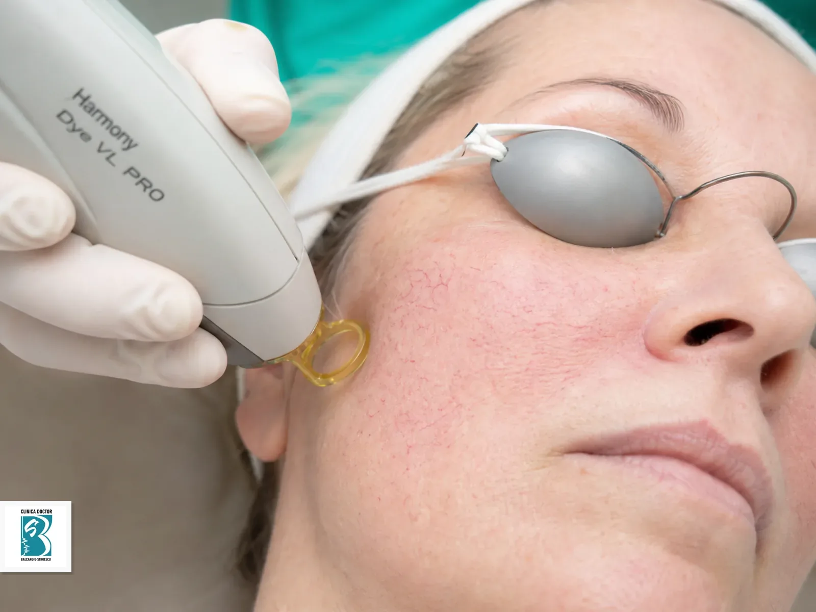 Tratament telangiectazii / venectazii - fata (Laser Harmony Dye VL PRO) Tratament laser vascular pentru zonei tratate, cu telangiectazii fine