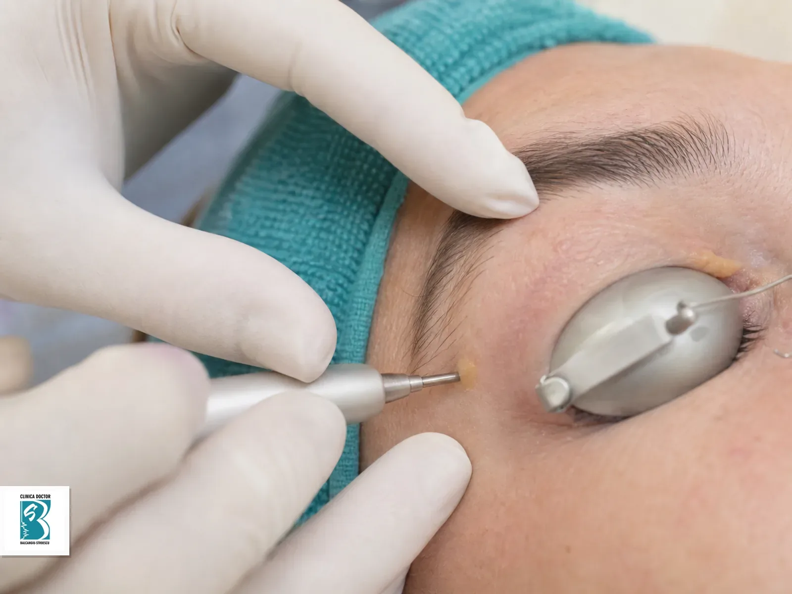 Xantelasme (xantoane) - tratament laser 1 leziune Tratament laser pentru xantelasma pe pleoapa cu protectie oculara corecta