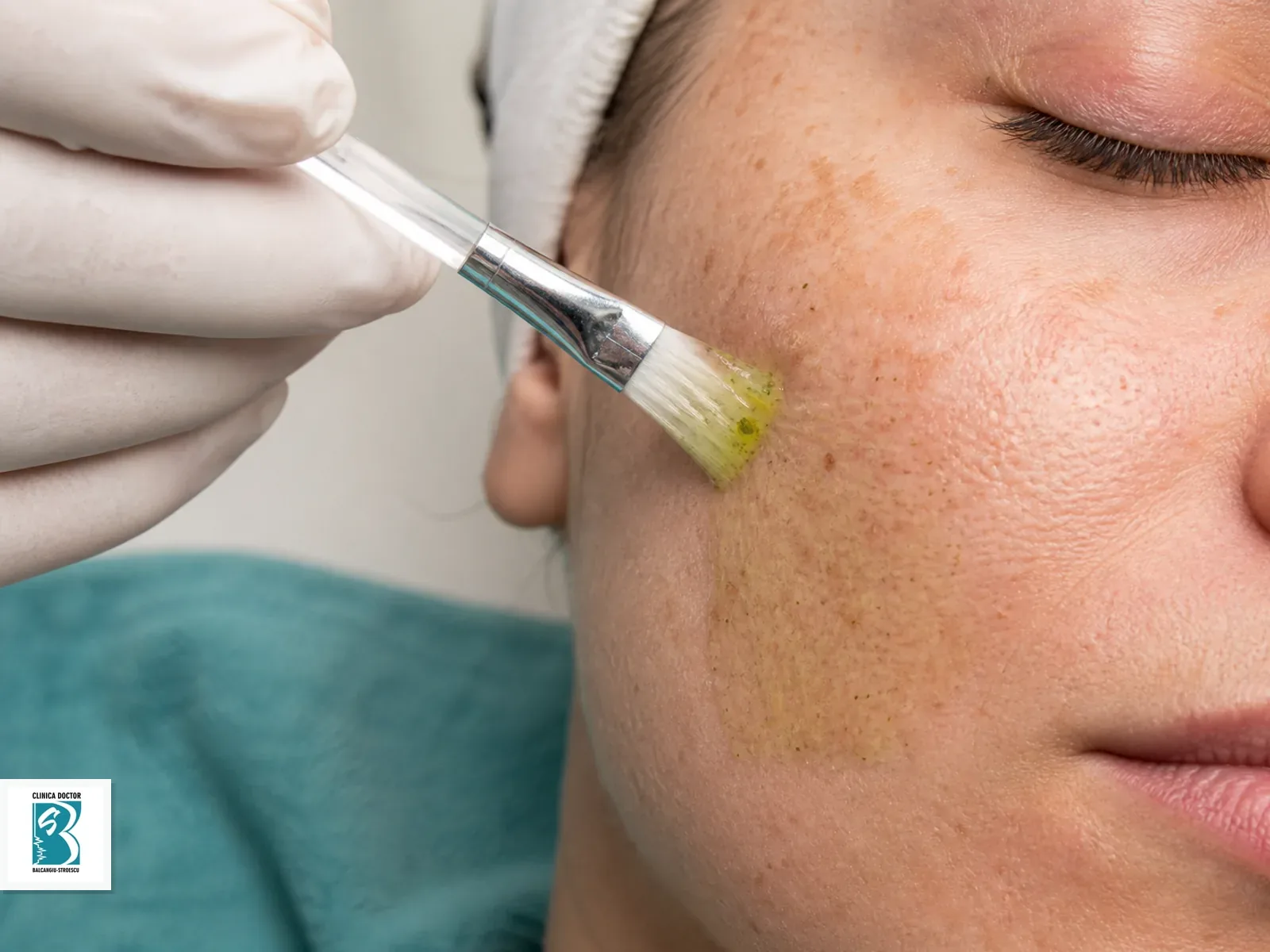 BioRePeel – peeling biostimulator pentru regenerarea pielii Aplicare controlată de tratament cutanat pentru BioRePeel – peeling biostimulator pentru regenerarea pielii, pe piele pregătită clinic