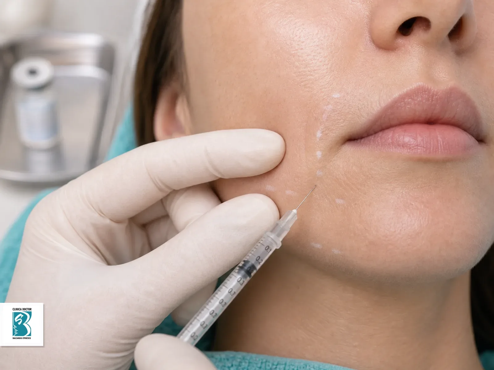 Hialuronidază – topire acid hialuronic (1 ml) Tratament injectabil pentru Hialuronidază – topire acid hialuronic (1 ml), cu seringă fină și marcaje de planificare