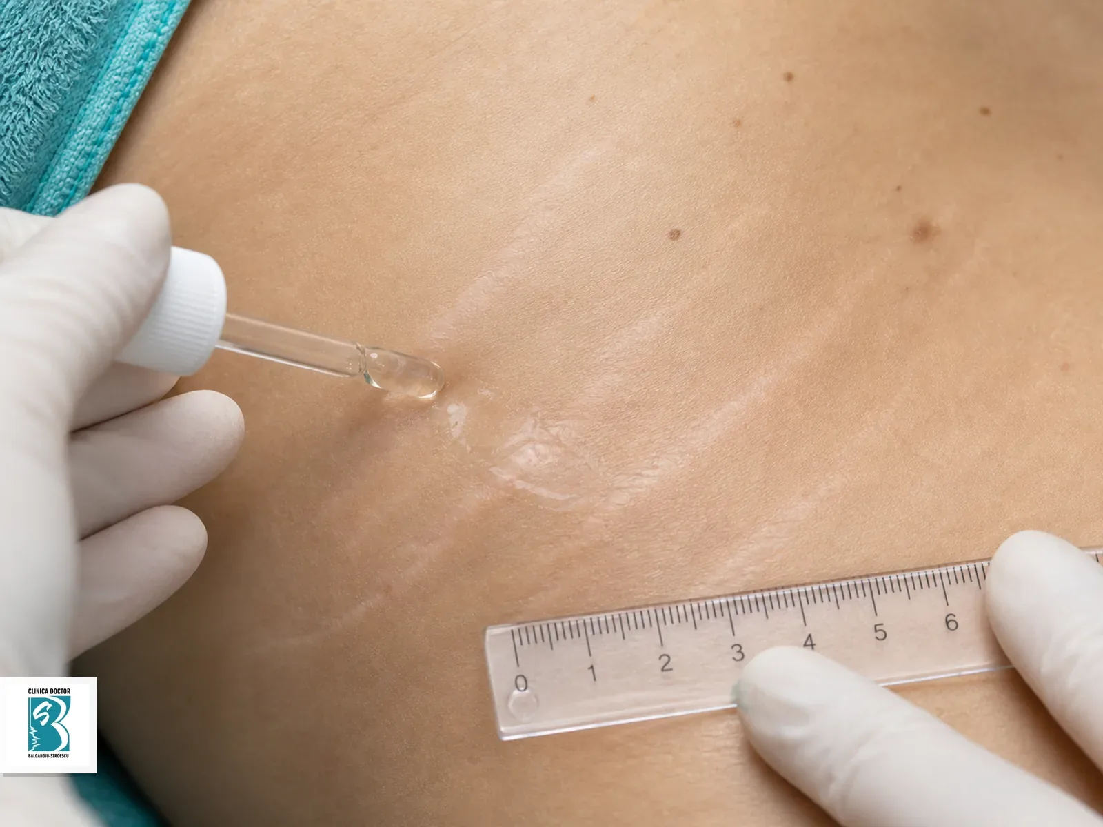 Tratament PB Serum pentru PB Serum – tratament pentru vergeturi și cicatrici, cu marcaje clinice și administrare locală