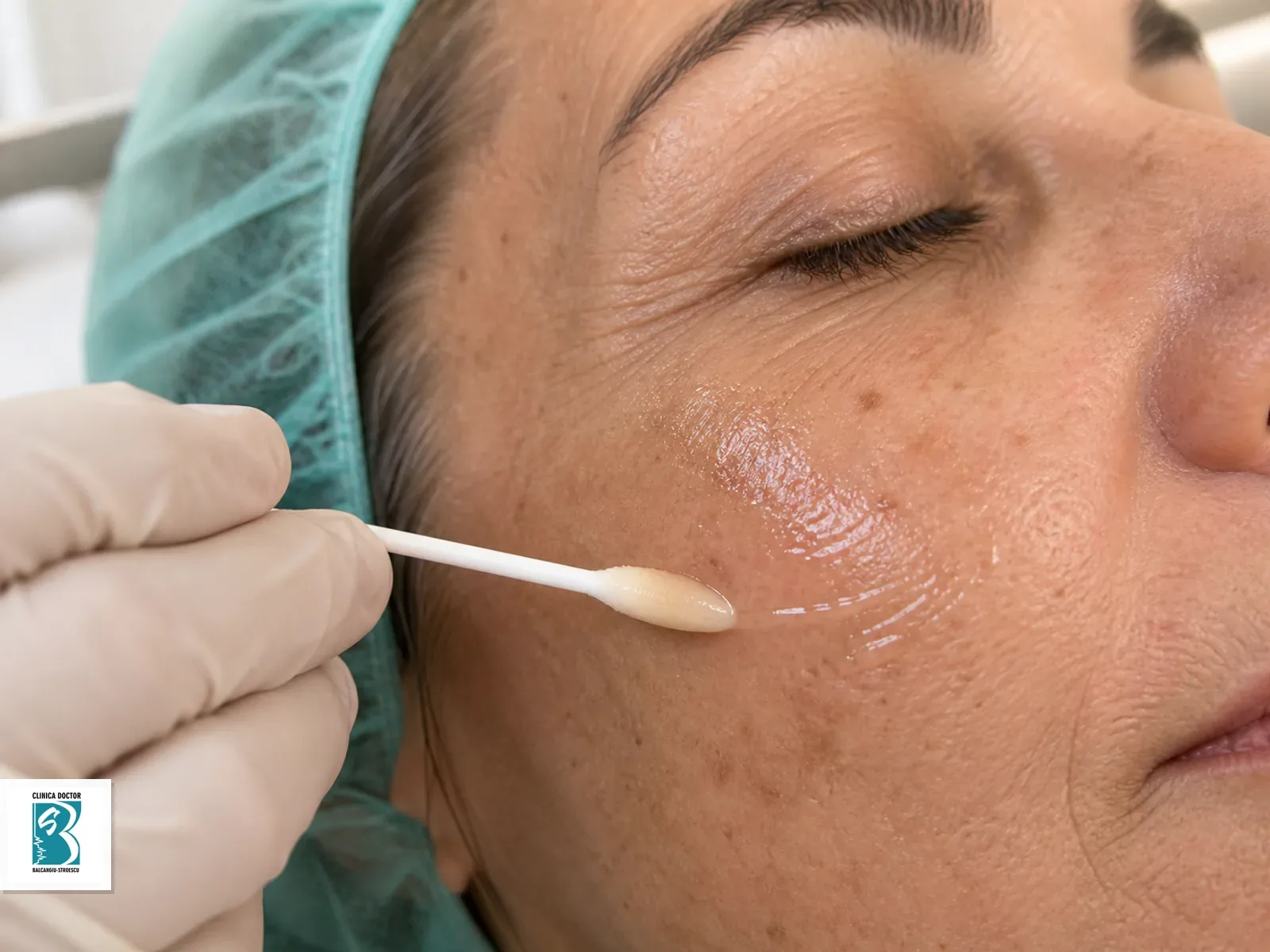 Peeling chimic mediu-profund cu fenol – tratament dermatologic pentru rejuvenarea pielii Aplicare controlată de tratament cutanat pentru Peeling chimic mediu-profund cu fenol – tratament dermatologic pentru rejuvenarea pielii, pe piele pregătită clinic