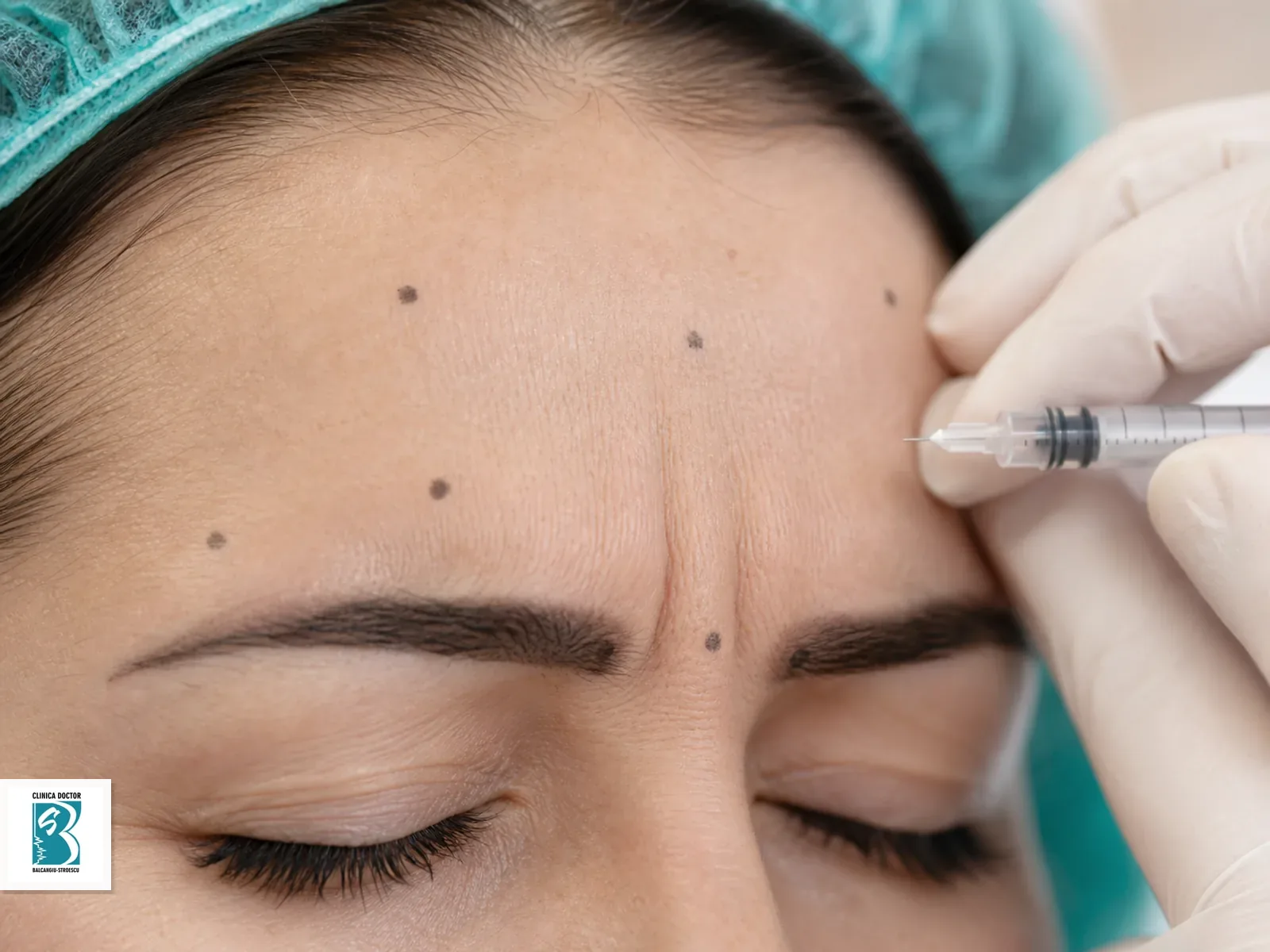 Tratament injectabil cu toxină botulinică pentru Toxină botulinică - 1 zonă, cu puncte de tratament marcate