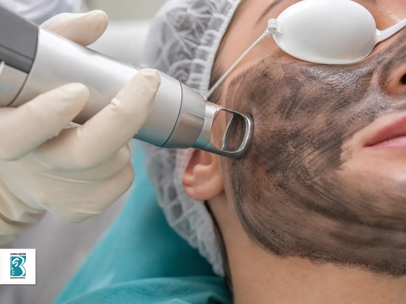V-Carbon Sistem Dual + Laser Q-Switch – tratament facial pentru curățare profundă și rejuvenare Aplicare controlată de tratament cutanat pentru V-Carbon Sistem Dual + Laser Q-Switch – tratament facial pentru curățare profundă și rejuvenare, pe piele pregătită clinic