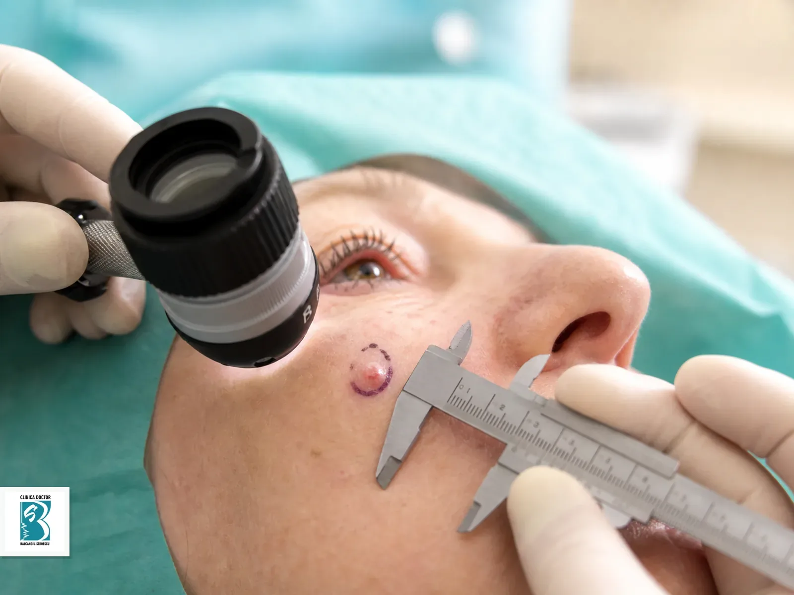Chirurgie carcinom bazocelular medic primar Planificare chirurgicala pentru carcinom bazocelular cutanat medic primar