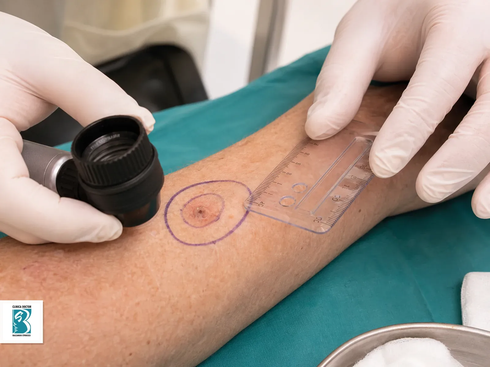 Planificare chirurgicala pentru carcinom spinocelular cutanat medic primar