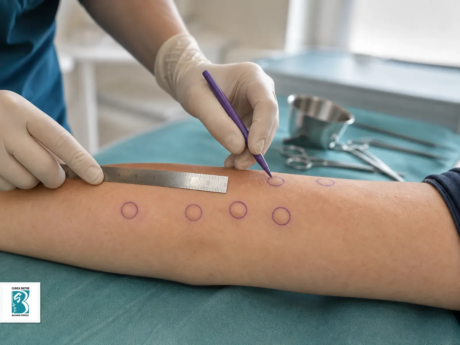 Cura chirurgicala a 5-7 lipoame intr-o sesiune Marcaje chirurgicale pentru excizia mai multor lipoame in aceeasi sesiune