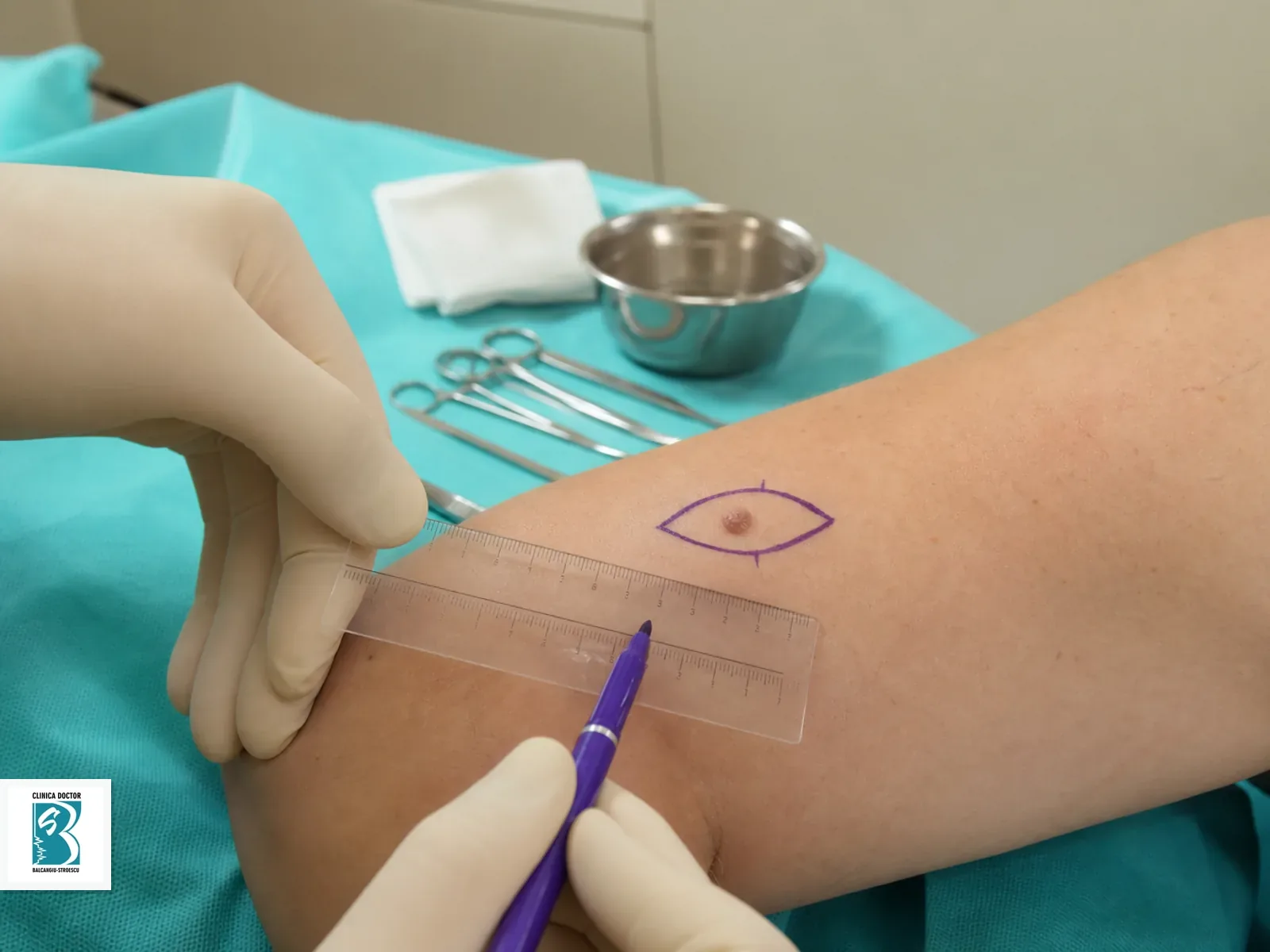 Excizie leziune cutanata 1-3 cm - medic primar chirurgie plastica Excizie planificata pentru leziune cutanata 1-3 cm medic primar