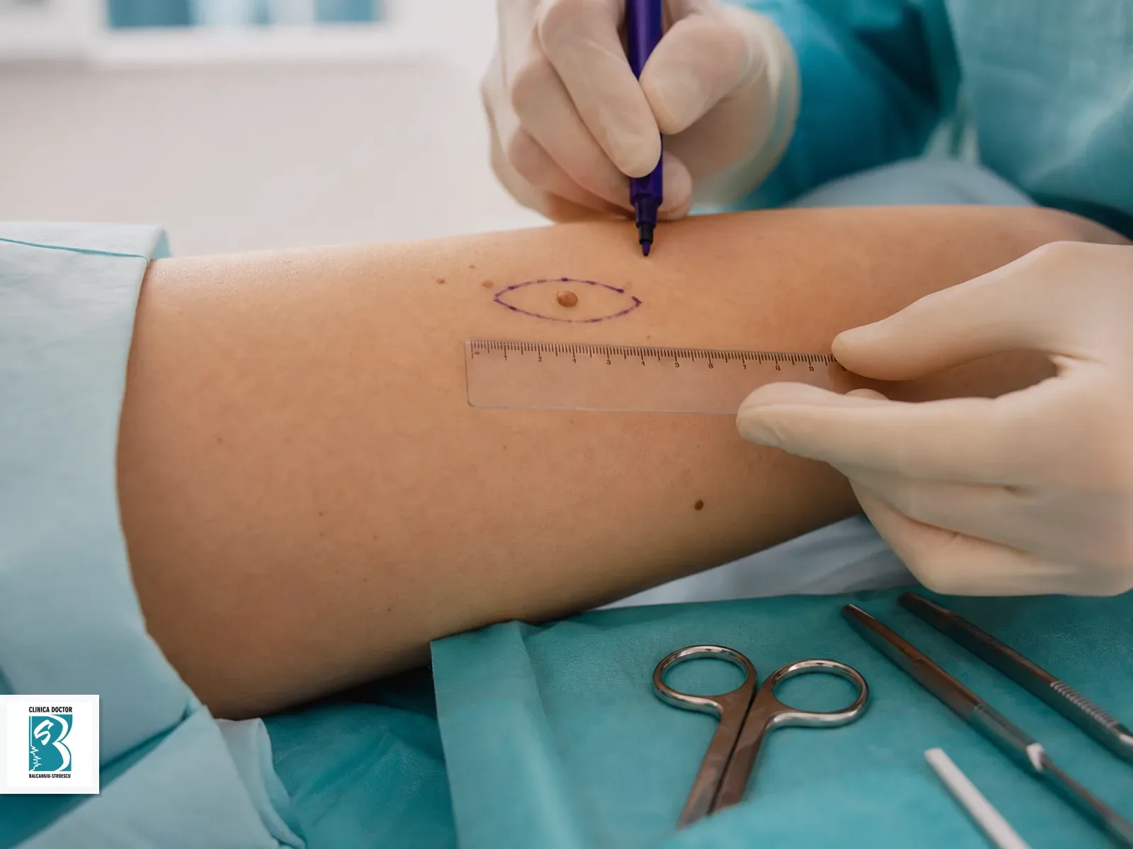 Excizie planificata pentru leziune cutanata 1-3 cm medic specialist
