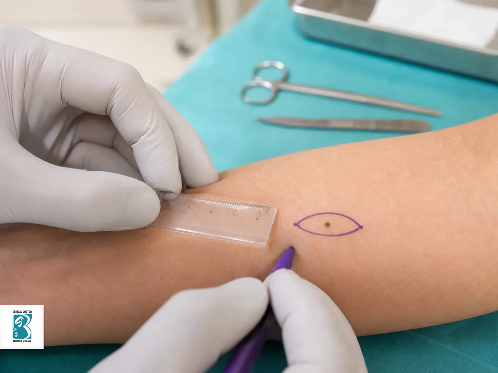 Excizie planificata pentru leziune cutanata sub 1 cm medic specialist