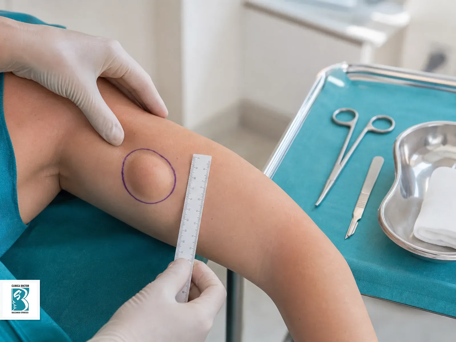 Excizie lipom 2-5 cm - medic specialist chirurgie plastica Marcaj preoperator pentru excizie lipom 2-5 cm medic specialist